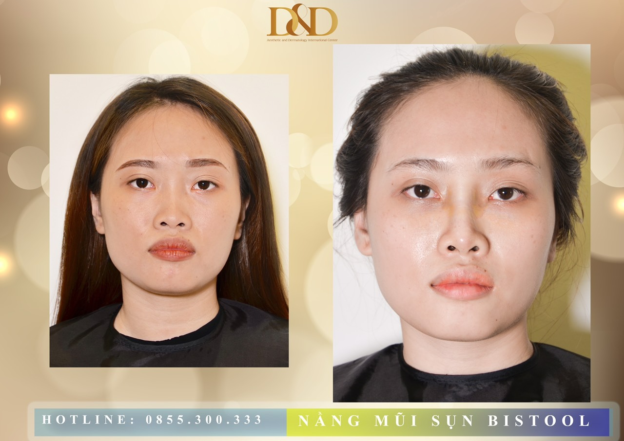 Khách hàng nâng mũi bọc sụn tại Viện Thẩm mỹ Quốc tế D&D