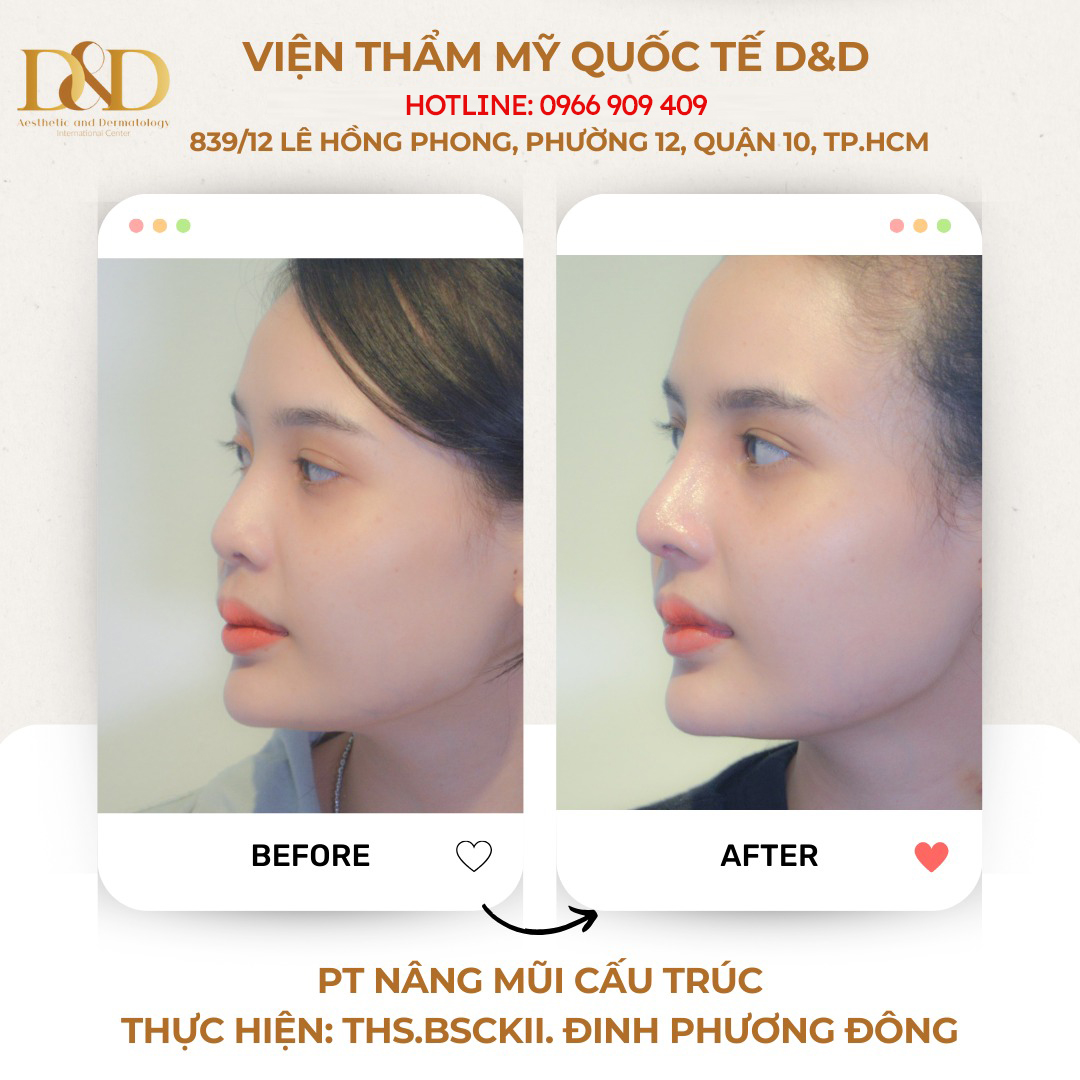 Nâng mũi cấu trúc cho phép bác sĩ can thiệp để nâng cao phần sống mũi và tái cấu trúc toàn bộ phần đầu mũi