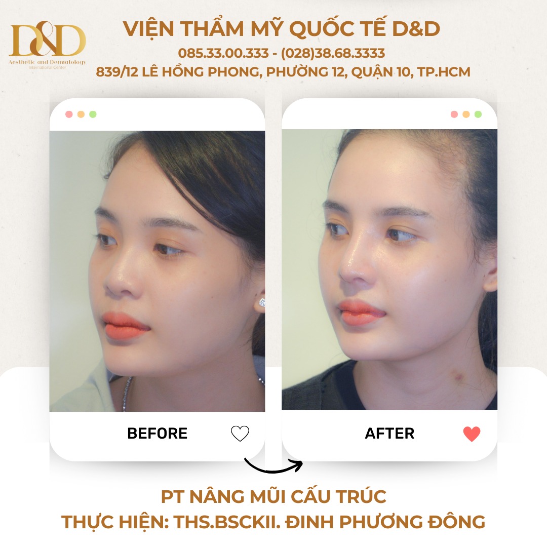 Hình ảnh trước sau, cho phép so sánh độ cao của phần sống mũi, sau khi thực hiện nâng mũi cấu trúc bởi bác sĩ CKII Đinh Phương Đông