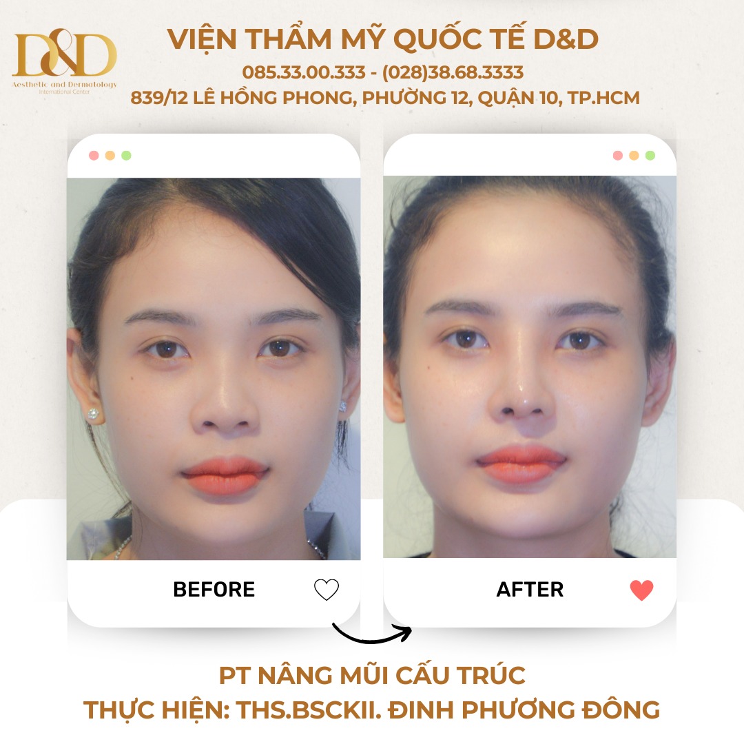 Nâng mũi cấu trúc cho phép khắc phục hiệu quả nền mũi nguyên thủy, mũi bị biến chứng sau tai nạn, mũi thấp sống bẩm sinh